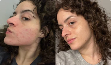 Before and After